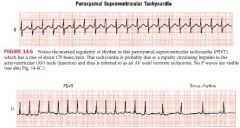 caused by a rapidly circulating impulse in AV node area
produces a very rapid and regular SV rhythm 140-250 bpm and are initiated by an APB
P waves are hidden in QRS complex 
May cease spontaenously

A type of junctional rhythm