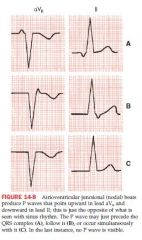 AV junction functions as ectopic pacemaker
This retrograde stimulation of atria produces a postiive p wave in aVR and negative P wave in lead II
Narrow QRS complexes
P wave can occur before,or after the QRS complex, or simultaneously which show...
