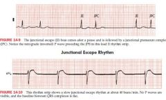 a beat that comes after a pause when normal sinus pacemaker fails to function 
"a safety beat"
HR is usually slow 30-50 bpm

Seen in sick sinus syndrome, digitalis toxicity, excessive effects of BB or CCB, acute MI, hypoxemia, and hyperkalemia