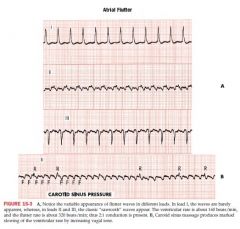 atrial rate is 250-350 bpm
example of reentrant arrhythmia
originates in the RA traveling top to bottom to top

atrial rate is 300/min and ventricular rate is about 150. 100, or 75/min
sawtooth pattern

occurs in pts with mitral disease, ch...