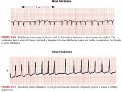 atria depolarization rate is between 350-600 cycles/min

irregular wavy baseline pattern in place of normal P waves
ventricular rate is irregular