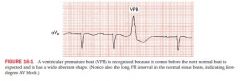 QRS complexes are wide
occur before the next normal beat is expected; precede a sinus P wave but before a normal QRS complex
aberrant in appearance
T wave and QRS complex point in opposite direction

VPB may be followed by a nonsinus P wave (...