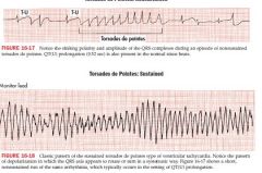 polymorphic Vtach

prolong QT, prominent U waves
often initiated by a VPB 

caused by quinidine and other drugs