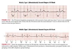 PR interval lengthens progressively with successive beats until one sinus p wave is not conducted
Pr interval after non conducted p wave is shorter than the one just before