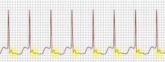 WPW syndrome associated (bypass tract)

may show p waves occurring visibly after QRS complexes in the ST segment