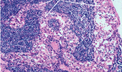Lymph node. Subcapsular and medullary sinus filled with reactive macrophages