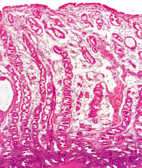 Secretory endometrium. Stratum functionalis (= compactum+ spongiosum)at the onset of menstruation spiral arterioles constrict in the absence of progesteron
