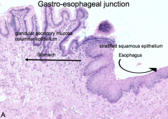 Gastro-esophageal junction