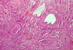 Invasive Colonic Adenocarcinoma
Invading, glands go into different wall of colon. abmoral glands in submucosa