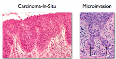 Carcinoma in situ vs microinvasion