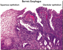 Barret's esophagus