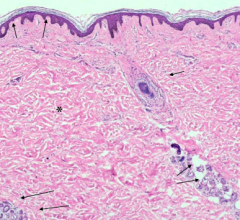 Papillary dermis is under epidermis. Reticular dermis contains sweat glands