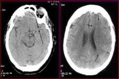 Earliest changes seen on CT Reflect changes in the water content of the brain due to evolving cytotoxic oedema
- loss of gray white junction, loss of definition of Basal ganglia, insular ribbion, internal capsule

- hyperdense MCA sign