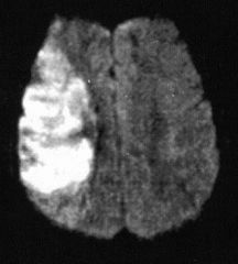 •Diffusion restriction within 30 mins of event, maybe earlier.
•Cytotoxic oedema 
swelling of gray matter
increased signal intensity on T2 & FLAIR
•Loss of intravascular flow voids