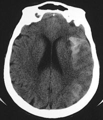•Haemorrhage into the subarachnoid space which may be due to
•Aneurysm rupture
•Trauma

POORLY defined