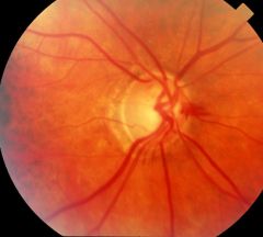 ›Age 50yrs 1% Australians are affected
›Age 80 yrs 10% Australians are affected
›50% of Australians who have glaucoma currently Do Not Know they have the condition