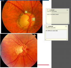 ›Asymmetry of cups in both eyes > 0.2
›Focal loss of neuroretinal rim /notch / acquired pit
›Changes in vessels on optic disc: nasalisation, bayoneting, flyover vessels, focal narrowing of vessels, disc haemorrhage