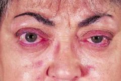 Opthalmopathy showing periorbital oedema, chemosis, sceral injection and proptosis. Lid retraction is obscured by oedema