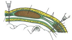 •Skin
•Superficial fascia
•Deep fascia (very thin)
•Linea alba
•Transversalis fascia
•Extraperitoneal fat
•Parietal peritoneum