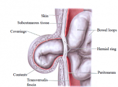 (1) Hernial sac Usually a pouch of peritoneum 
(2) Contents Generally structures from the abdominal cavity e.g. fat, omentum or bowel 
(3) Coverings Contains layers from the abdominal wall through which the hernial sac passes