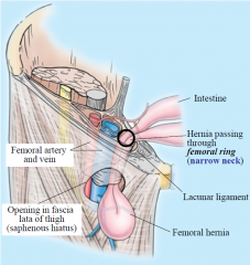 - Passes through femoral ring into thigh 
- Protrudes through saphenous opening in fascia lata 
- More common in females than males (4:1)
- Femoral ring forms neck of the hernia. Boundaries: 
    - Inguinal ligament (anterior) 
    - Pectineu...