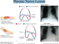 A phrenic nerve lesion will result in a raised hemidiaphragm on inspiration, ipsilateral to the lesion