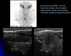 sub-acute thyroiditis: thyroid hormone release due to gland inflammation (post viral usually). Common cause of hyperthyroidism