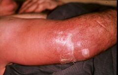 bugs that cause this
- olecranonoe bursitiis
- secondary infection into the skin and then get a true cellulitis