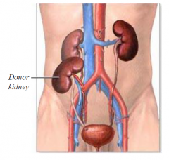 •Donor kidney transplanted  iliac fossa (extraperitoneal)
•Donor’s renal artery & vein connected to external iliac vessels, ureter connected to bladder
•Patient’s kidneys usually remain in place