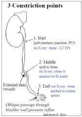 3 sites of constriction/narrowing along ureter where ureteric calculus may lodge.
 +/- ureteric colic (loin to groin pain);  +/- hydroureter and hydronephrosis (with progressive renal parenchymal damage)