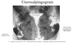 Uterosalpingogram (hysterosalpingogram)
- Radiopaque material is injected into uterus through the external os.
- Contrast medium fills triangular-shaped cavity of the body, the lumen of uterine tube, and if the uterine tubes are patent it spills...