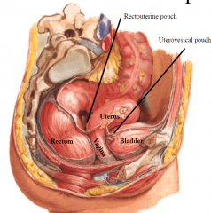 Peritoneal relationships: peritoneum reflects from rectum to posterior fornix and uterus
creating the rectouterine pouch; and reflects from uterus to bladder creating the
uterovesical pouch
Superior relationships: intestines. Posterior relation...