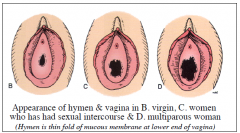 its at the boundary between the embryological outer third of vagina coming from perineium and the inner 2/3