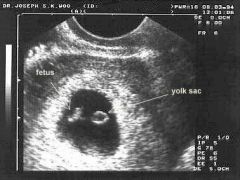 – embryo can be seen on ultrasound
– sac 20-25 mm, embryo 10 mm
– arm and leg buds become visible
– eyes and ear structure begin to form
– formation of tissue that develops into vertebra & some other bones
- further development of h...