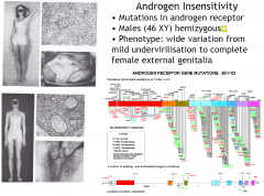 • Mutations in androgen receptor
• Males (46 XY) hemizygous
• Phenotype: wide variation from mild undervirilisation to complete female external genitalia

the receptor is on the X chromosome and so will express the receptor with no back up