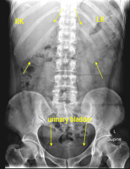 
kidney L1 to umbilicus

covered by 12th rib

3 vertebral bodies long in the adult

about 9-13 cm long

left usually lies slightly superiorly to right (because of liver)