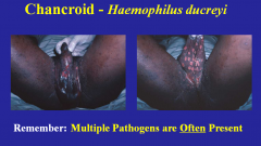 Gram negative bacillus

Requires X-factor (hemin)

Incubation period 4-7 days

First symptom - ulcer