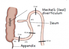 resembles the appendix 
is usually within a metre of ileocaecal junction
inflammation may mimic pain of appendicitis
is the connection to the embryonic yolk sac