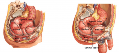 Rectum has peritoneum on front & sides of upper 1/3rd, on front of middle 1/3rd and no peritoneum
related to lower 1/3rd. Peritoneum reflects from rectum onto pelvic viscera forming rectouterine pouch
in females & rectovesical pouch in males.

...