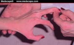 Flick middle finger nail. Causes flexion of index finger, middle finger will extend