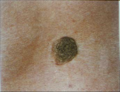 Seborrheic Keratosis:
- common benign epithelial tumor
-Appear after age 30
-No malignant potential
-Discrete
-Stuck on
-greasy
-warty
-brown, grey, tan papules and plaques
-upper extremities and trunk
Treatment: light electrocautery, cyrosurger