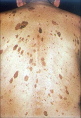 Seborrheic Keratosis:
- common benign epithelial tumor
-Appear after age 30
-No malignant potential
-Discrete
-Stuck on
-greasy
-warty
-brown, grey, tan papules and plaques
-upper extremities and trunk
Treatment: light electrocautery, cyrosurger