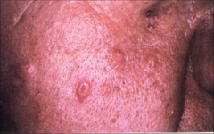 Sebaceous Hyperplasia:
- 1-3 mm
-smooth papules of enlarged sebaceous glands
-common in older people
-pale
-yellow
-dome
-umbilicated papules
- forehead, cheeks, lower lid, nose
-Treatment: electrocautery