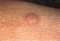 Dermatofibroma:
- common button like dermal papule/ nodule
-3-10 mm
-fibrous reaction to trauma or bite
-dimple sign
-lateral compresion with thumb and index finger produces depression or dimple
-legs, arms. trunks
-Treatment: Cryo, surgery