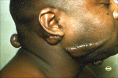 Keloids:
-excessive fibrous repair tissue after cutaneous injury extending beyond site of injury with claw like extensions
-all ages male and female
-black with blood group A
-asymptomatic
-Well defined flesh colored firm papules to nodules
-ear lob