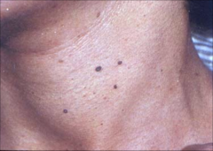 Acrochordons:
-Skin tages
-cutaneous papilloma
-soft fibroma
-middle aged and elderly female, obese
- soft skin colored oval
-sessile
-pedunculated papule
-1-10mm
-asymptomatic
-intertiginous- skin fold
-neck eyelids
-Treatment: scissor excisi