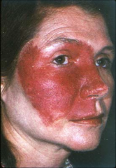 Blood Vessel Disorder:
1) Port Wine Stain:
- capillary malformations that do not undergo spontaneous involution, persistent
-irregularly shapped
-violaceous patch
-presents at birth
-do not cross midline
-dermatomal- one side of the bod
2) Variant