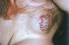 Cavernoius Hemangioma:
-blood vessel disorder
- rare-deep vascular malformation
-composed of capillary ,lymphatic and venous tissue
-soft compressible blue tinged erythematous nodules
- may invoulute
-Treatment: compression and surgery, corticostero