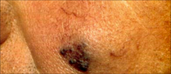 Venous Lake:
-dark blue to violaceous 
-soft papule
-on face, lips, ears
-over 50 yo
- may be related to sun exposure
-Treatment: electrosurgery, excision, laser