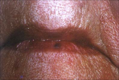 Venous Lake:
-dark blue to violaceous 
-soft papule
-on face, lips, ears
-over 50 yo
- may be related to sun exposure
-Treatment: electrosurgery, excision, laser